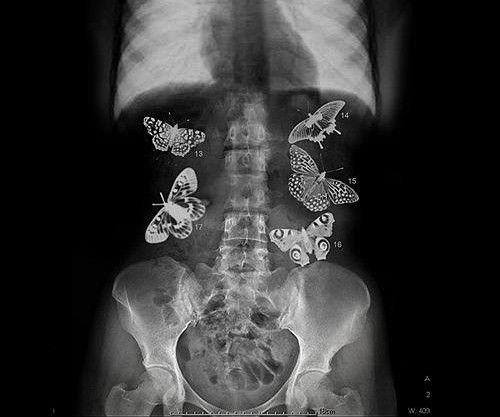 Motyle w brzuchu